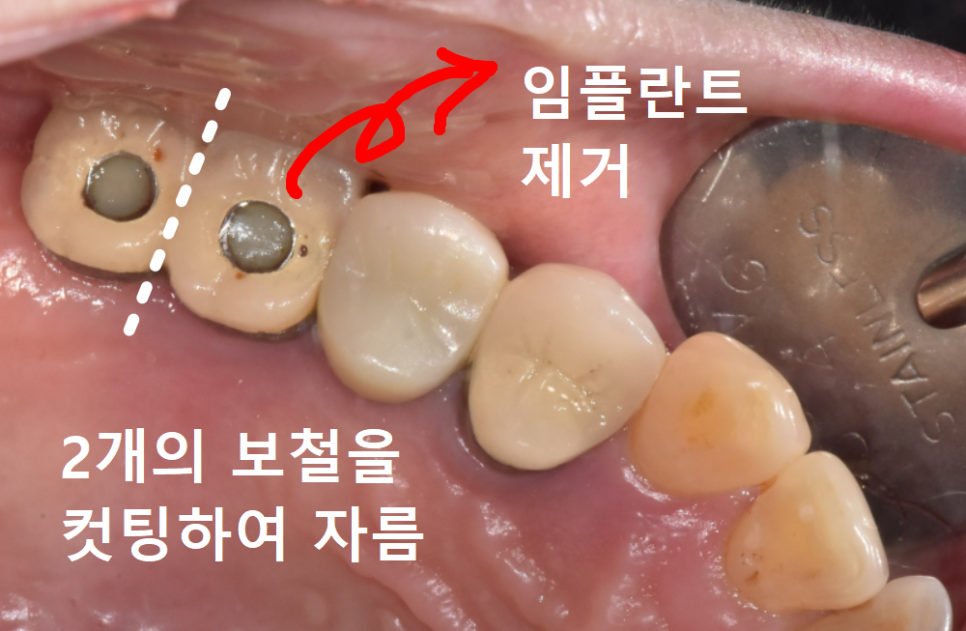 잇몸 고름 눌러보니 푹... 임플란트 주위염 방치했다가 재수술한 사례 관련 이미지 8