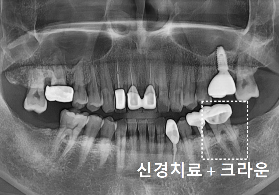 상일역 치과, 오래된 금니 빠짐, 같은 증상으로 내원했지만 전혀 다른 결과, 그 차이는? 관련 이미지 15