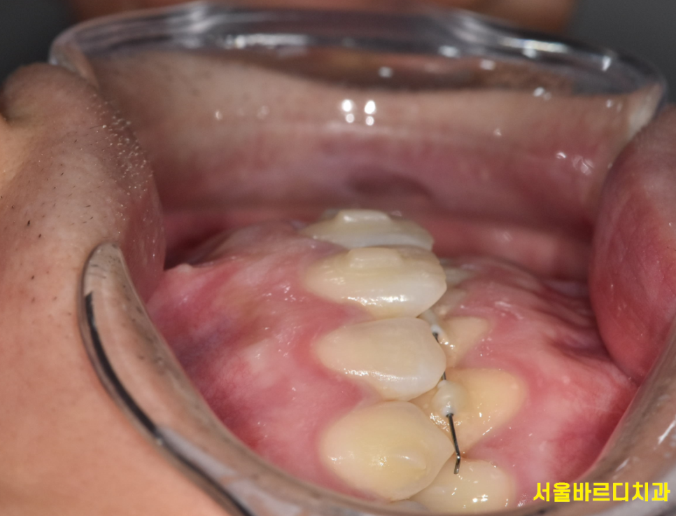 강동구 치아교정 병원에서 물어봐야할 필수 질문 4가지 관련 이미지 1