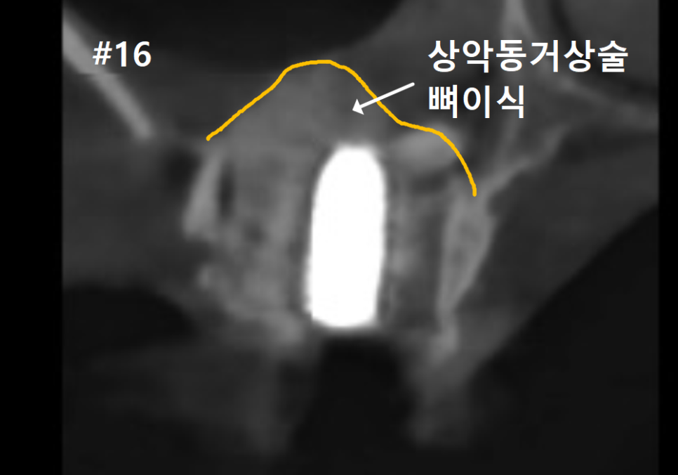 고덕동 스케일링 미루다 앞니 어금니 다 뽑고 임플란트 했습니다. 관련 이미지 17