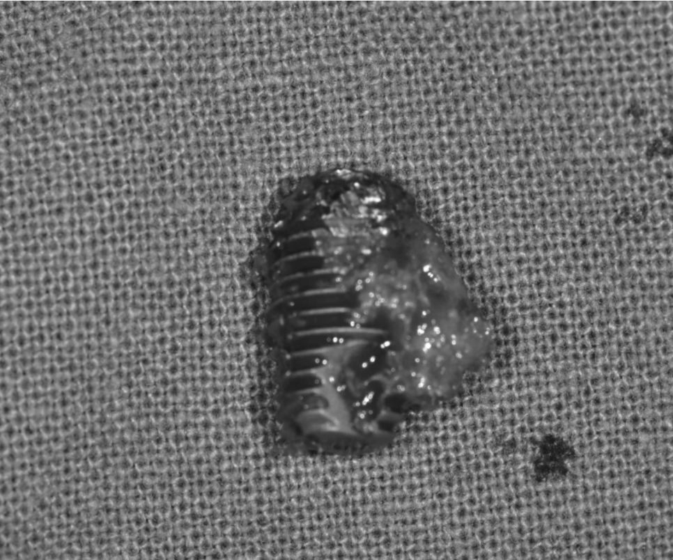 Is It Difficult to Shorten the Implant Procedure Period? Why It Differs from Person to Person image 8