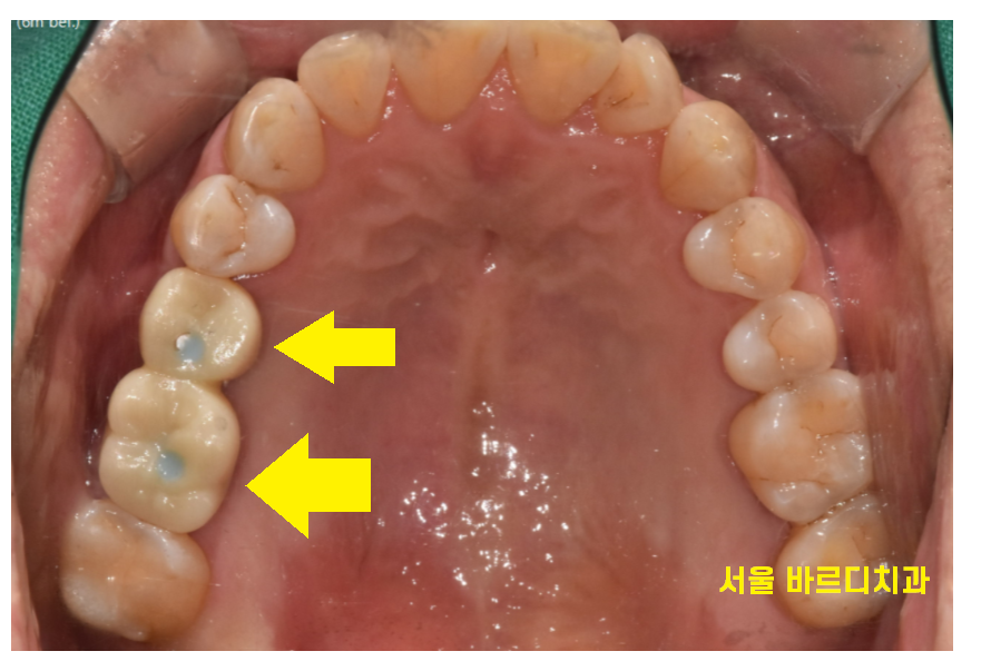 고덕역 임플란트 잇몸 뾰루지 뼈이식 두번 하여 해결했습니다. 관련 이미지 11