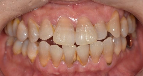 Gangdong-gu Dental Clinic: I Gag So Easily That I’m Too Afraid to Go to the Dentist. Tips to Reduce Gagging image 5