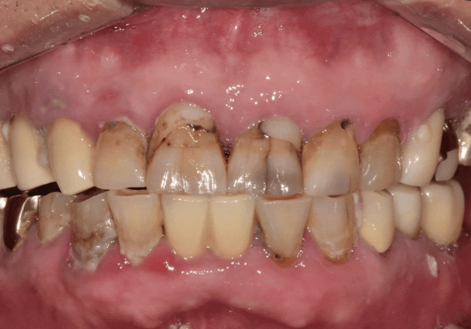 앞니 음식물 끼임, 왜 젊을 때보다 더 자주 발생하는 걸까요? 까맣게 변한 앞니 치료 사례 관련 이미지 17