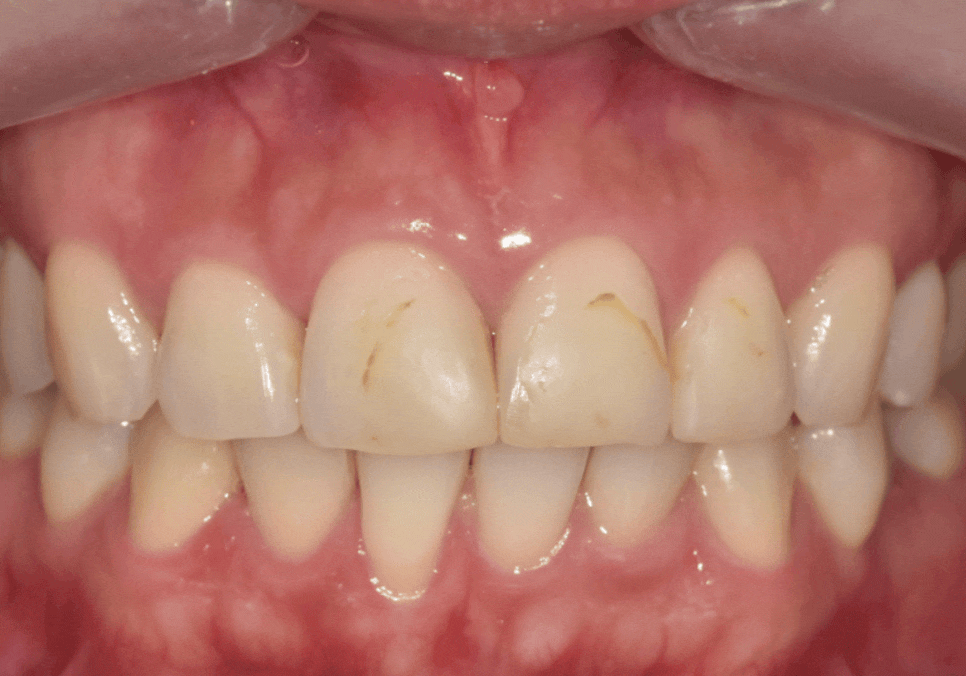 강일역 치과, 검게 보이는 앞니 레진 변색, 무조건 새로 해야 할까요? 관련 이미지 2