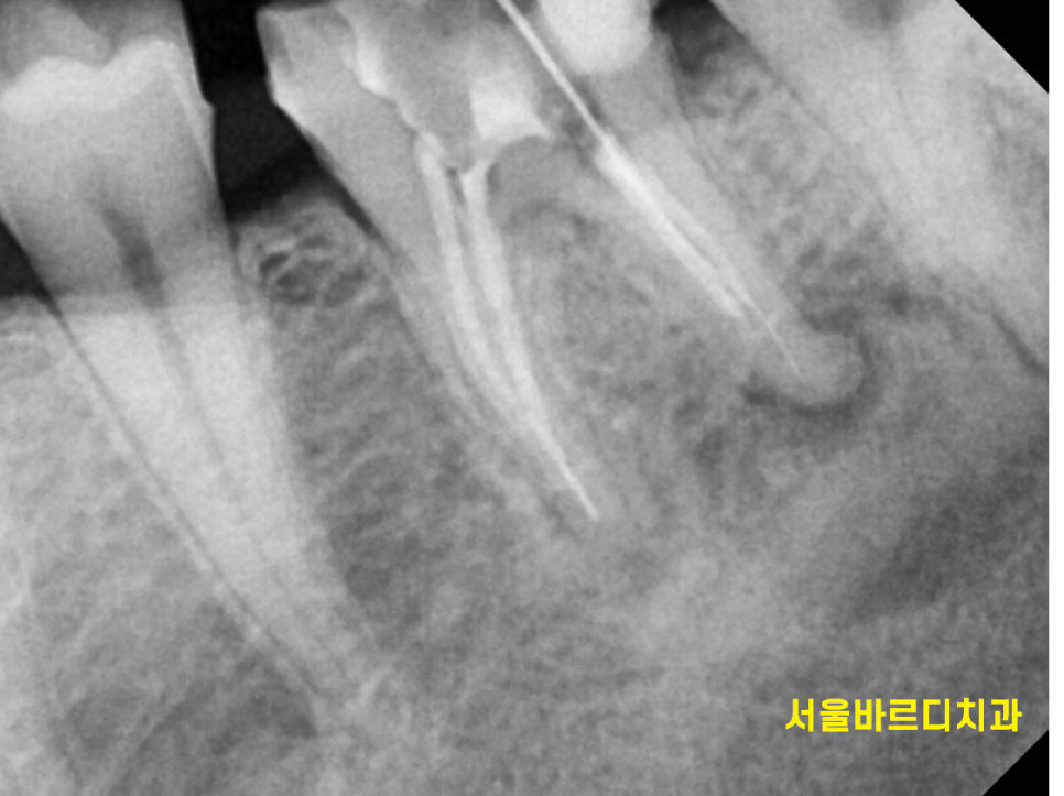 신경치료 염증 치아 다시 한번 치료하여 자연치아 살렸습니다. 관련 이미지 5
