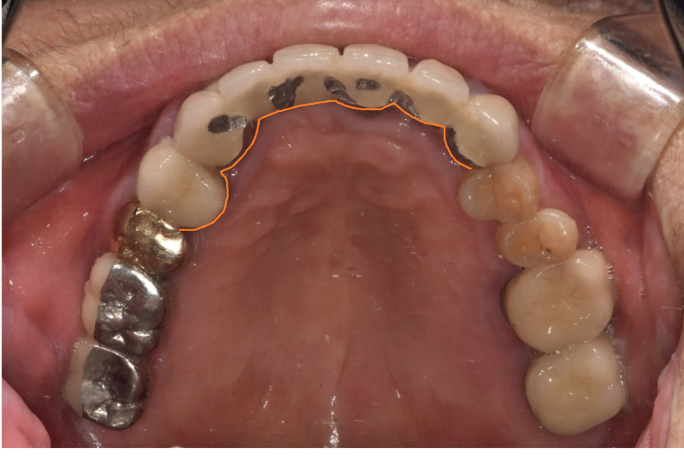 상일동 치과 충치로 인한 앞니 브릿지 파절 재건해보았습니다. 관련 이미지 4
