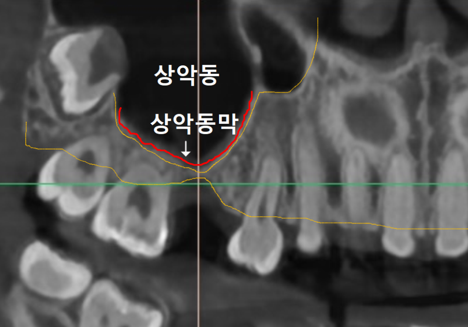 얇은 잇몸뼈 때문에 임플란트 하기 힘들다면? 저희는 관련 이미지 6