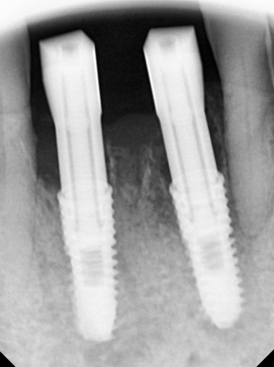 아래 앞니 임플란트 잇몸 염증 고름으로 인한 흔들림이 심해질때 관련 이미지 6