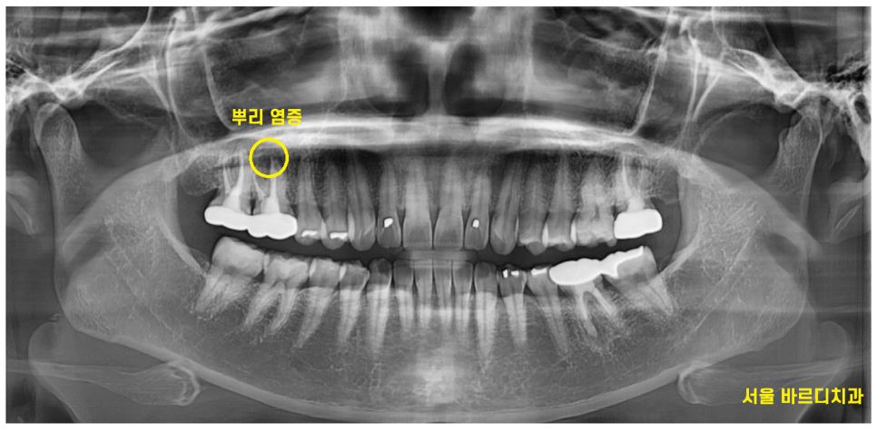 초이동 치과 치아 실금으로 조각나 신경치료까지 진행했습니다. 관련 이미지 2