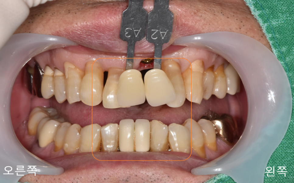 상일동치과 서울바르디치과 무절개 네비게이션 임플란트 치료증례 #3 관련 이미지 12