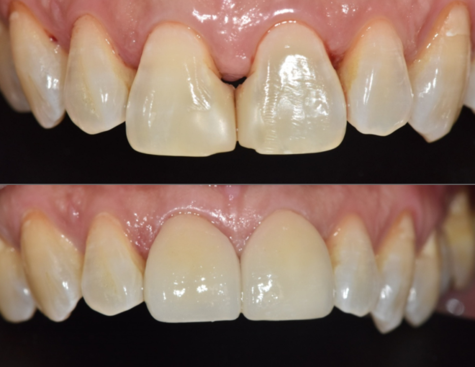 고덕동 치과 누런 이, 앞니 사이 틈, 잘못된 관리 때문일까? 관련 이미지 16