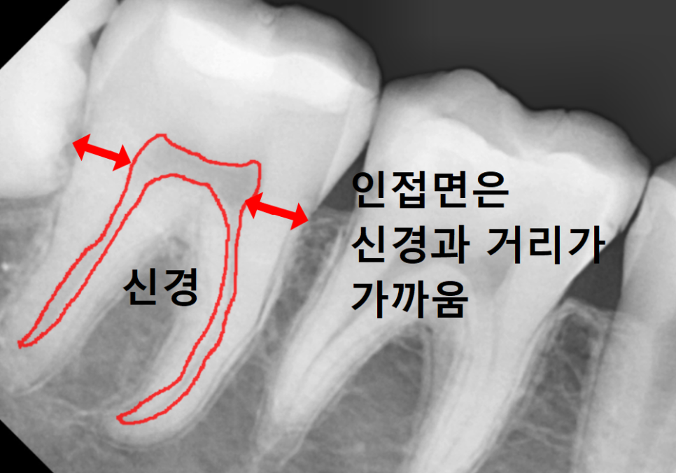 고덕동 사랑니 매복 발치, 안 아픈데 꼭 빼야 하나요? 관련 이미지 10