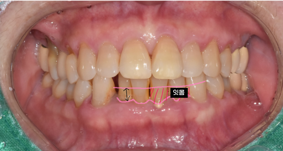 아래 앞니 임플란트 잇몸 염증 고름으로 인한 흔들림이 심해질때 관련 이미지 4