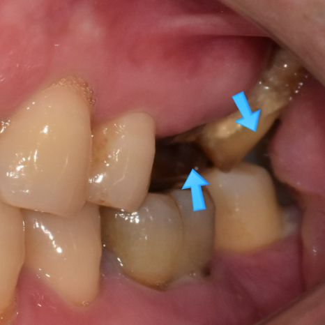 Gangdong-gu Dental Clinic: Are There Cases Where Implants Are Impossible? image 5