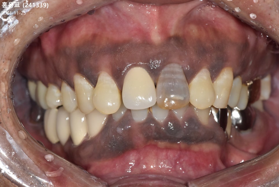 앞니가 검게 변색된 이유, 신경치료 후 꼭 크라운으로 씌워야 하는 걸까요? 관련 이미지 3