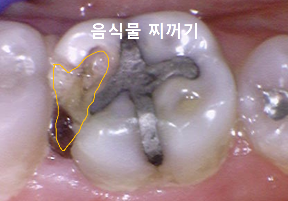 고덕동 어금니 사이 충치, 양치질 누구보다 열심히 하는데 왜 자꾸 생길까요? 관련 이미지 8