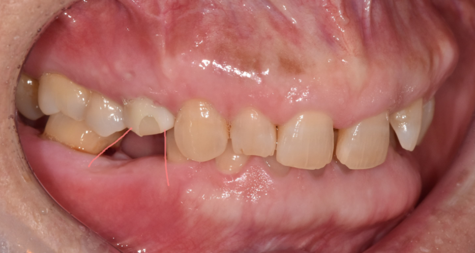 임플란트 볼씹힘 왜 생기고 어떻게 해결할까? 관련 이미지 3