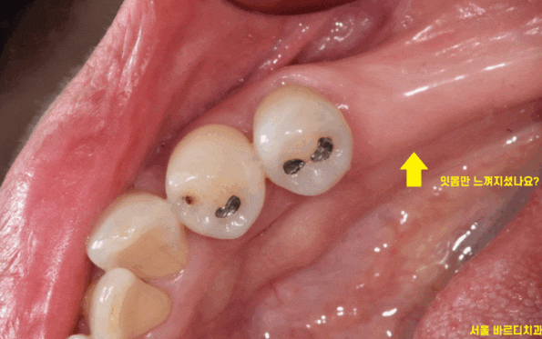 길동 치과 임플란트 2차 수술이요? 예전에 했잖아요 관련 이미지 1