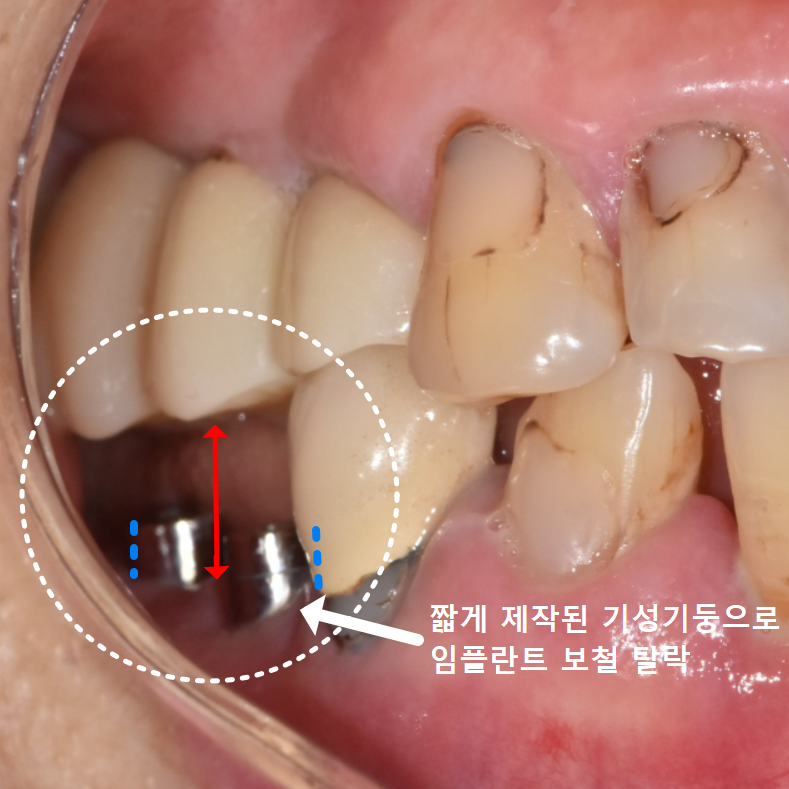 고덕동치과, 보험 임플란트? 추가 비용이 왜 나오는 거죠? 관련 이미지 6