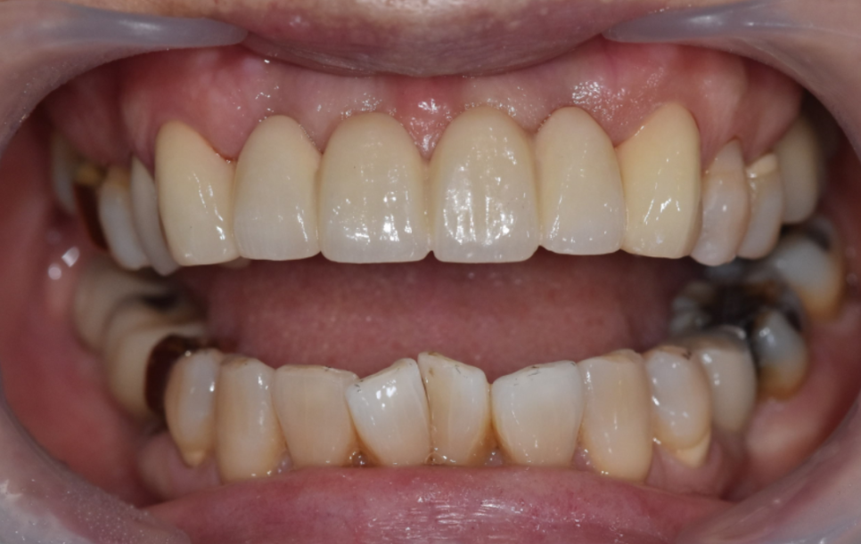 명일동 앞니 브릿지, 새로 교체 할 때 꼭 확인해 봐야 할 관련 이미지 12