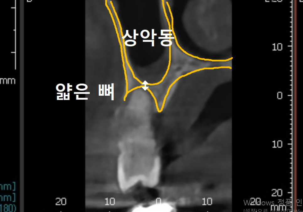 Gangil-dong Molar Implant, "It’s Loose—Can’t You Just Bond It with Resin?" image 9
