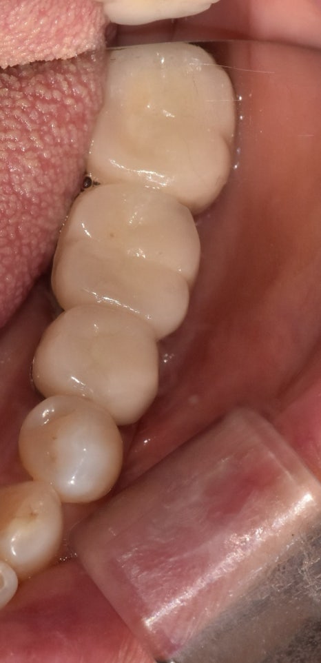 A Case of a 69-Year-Old Who Underwent Immediate Implant Placement After Extraction Due to Tooth Decay in Godeok-dong image 4