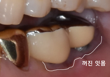 천호동 임플란트 재식립 사례, 평생 쓰는 줄 알았는데? 관련 이미지 6