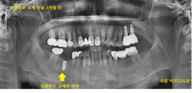 풍산동 치과 임플란트 염증으로 교체 한 환자분 케이스 관련 이미지 6
