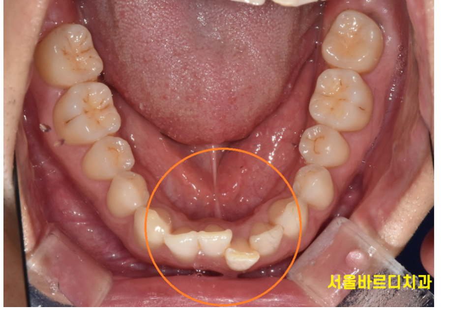 상일동 근처 교정 다시 삐뚤어진 치아 치료하기 관련 이미지 1
