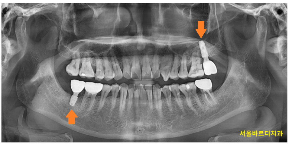 임플란트 수술 통증과 붓기 시기별 회복 과정 총정리! 관련 이미지 5
