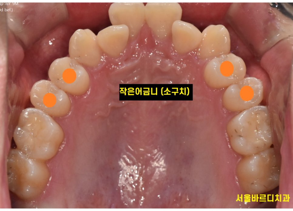 소구치 발치 교정 부작용은 없을까요?? 쌩니를 뽑는거라... 관련 이미지 3