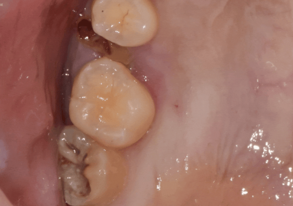 Myeongil-dong Implant Treatment in Your 20s: The Reason It Ended Up Requiring Bone Grafting After Thinking, “I’m Young, So It’ll Be Fine” image 2