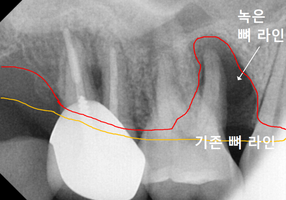 Sinusitis Caused by Teeth: Why Do You Tell Me to Go to the Dentist When My Nose Hurts? image 3