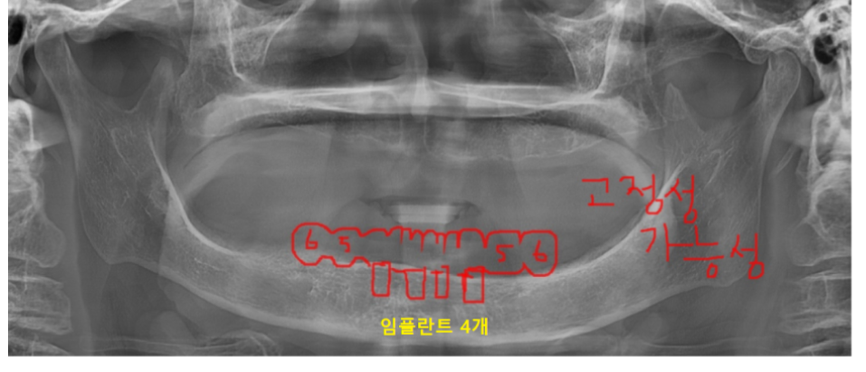 올온포 치아가 다 없어도 임플란트 4개만으로 복원이 가능합니다 관련 이미지 1