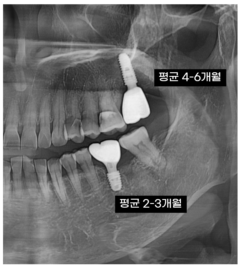 Is It Difficult to Shorten the Implant Procedure Period? Why It Differs from Person to Person image 5