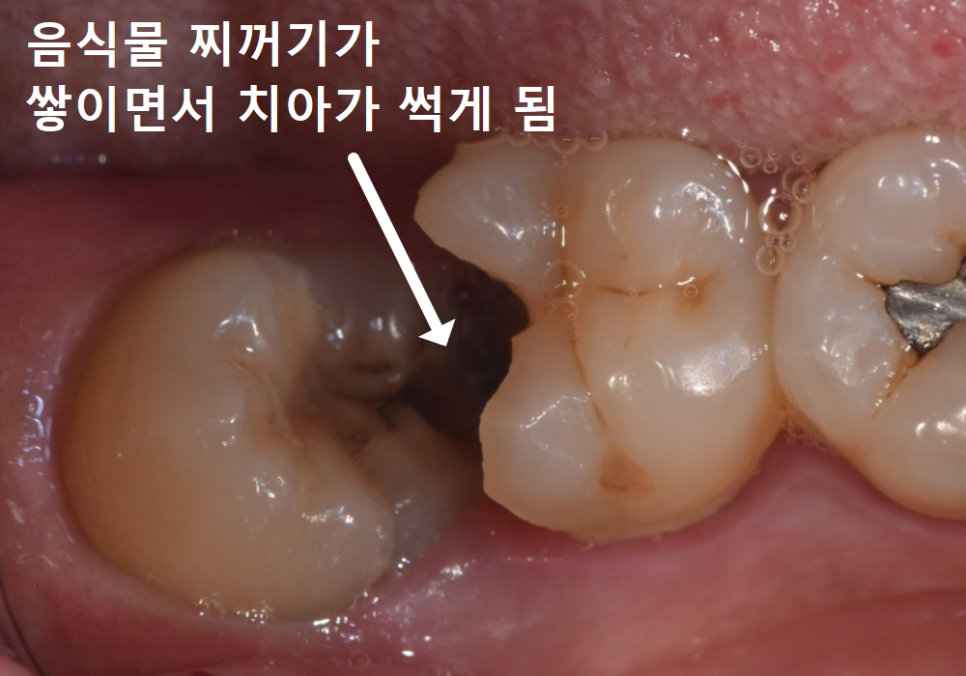 수평 매복 사랑니, 옆으로 누운 사랑니 때문에 멀쩡한 어금니까지 뽑은 사연 관련 이미지 5