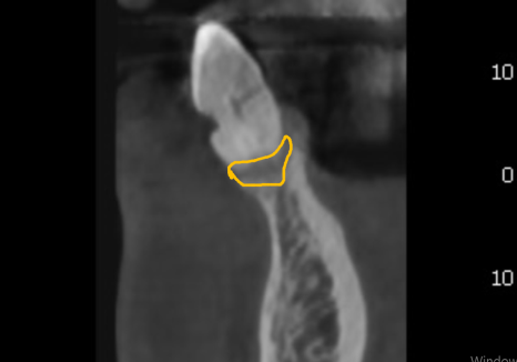 흔들리는 치아 묶어두는 잠간고정술, 오히려 잇몸뼈를 녹일 수도 있다고요? 관련 이미지 8