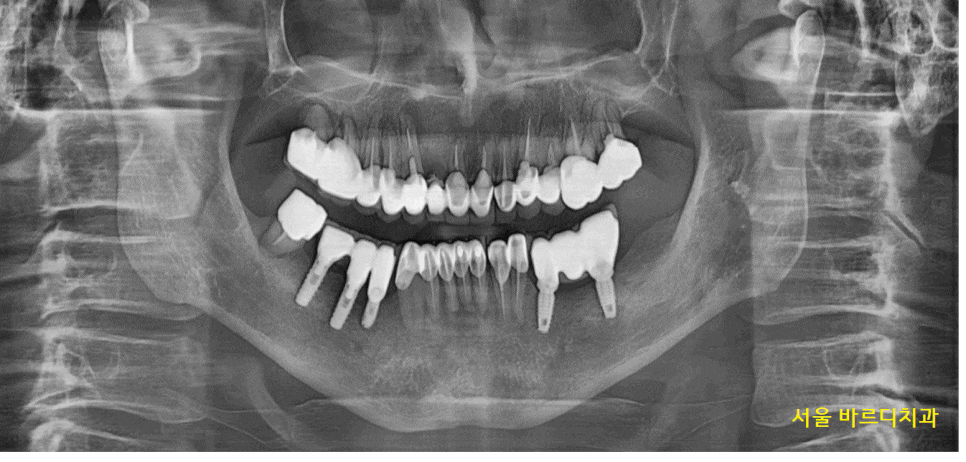 명일동 치과 뿌리 염증으로 입냄새가 나요 해결책은? 관련 이미지 1