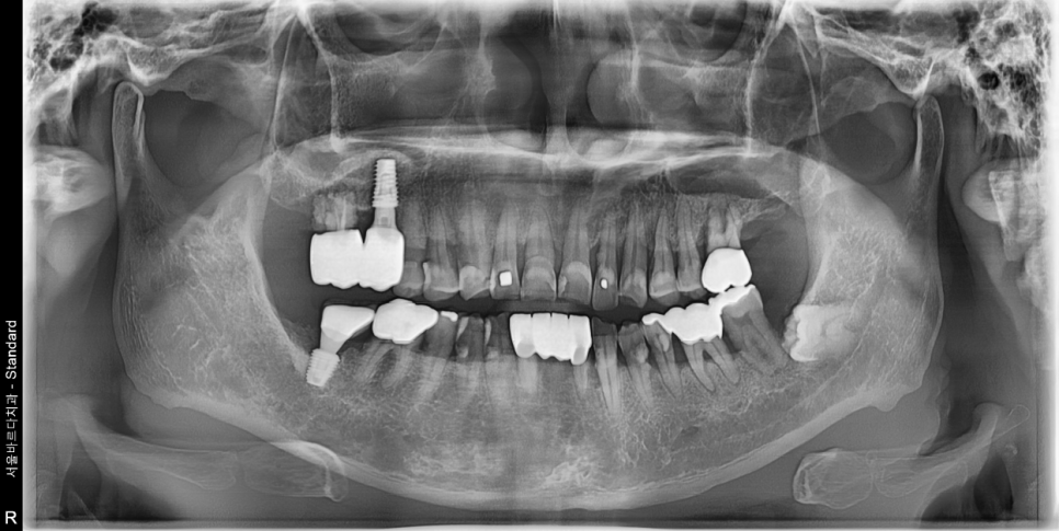 서울바르디치과 무절개 네비게이션 임플란트 치료증례 #8 관련 이미지 9