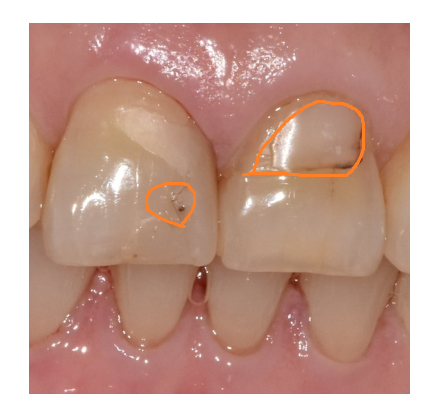 앞니 레진 재치료 변색 부위 연마하면 처음 느낌 그대로 관련 이미지 3