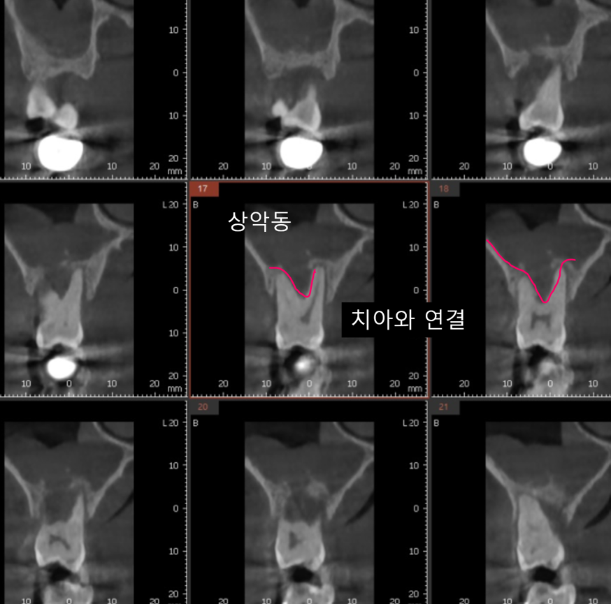 윗니 임플란트 상악동 부위 치아 염증으로 천공되었을 때 수술까지 관련 이미지 3