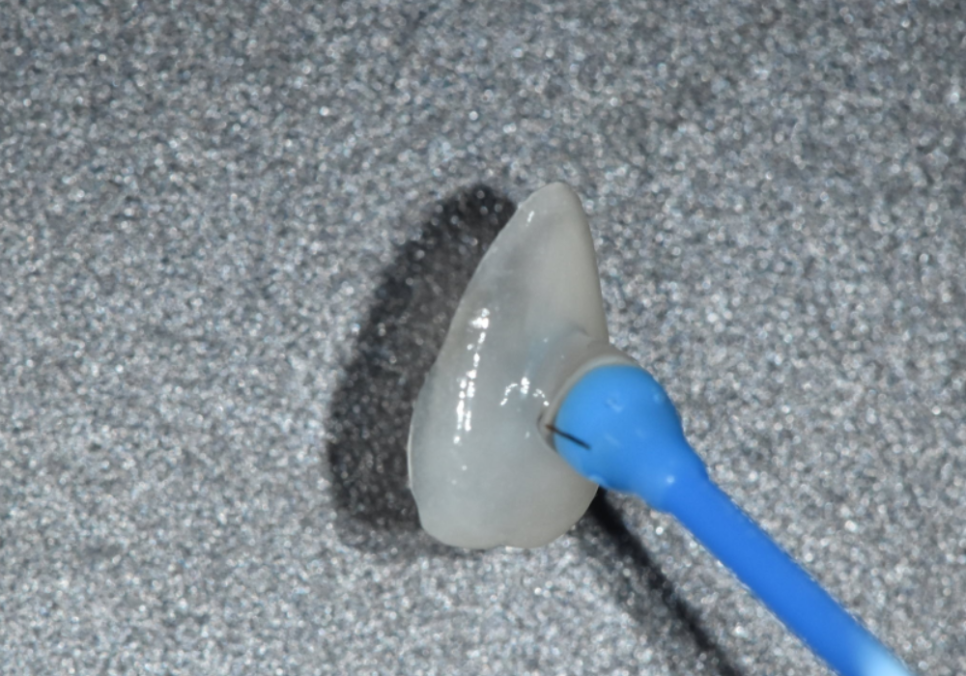 고덕동 치간 이개, 위 앞니 벌어짐, 교정? 라미네이트? 고민이시라면 필독 관련 이미지 7