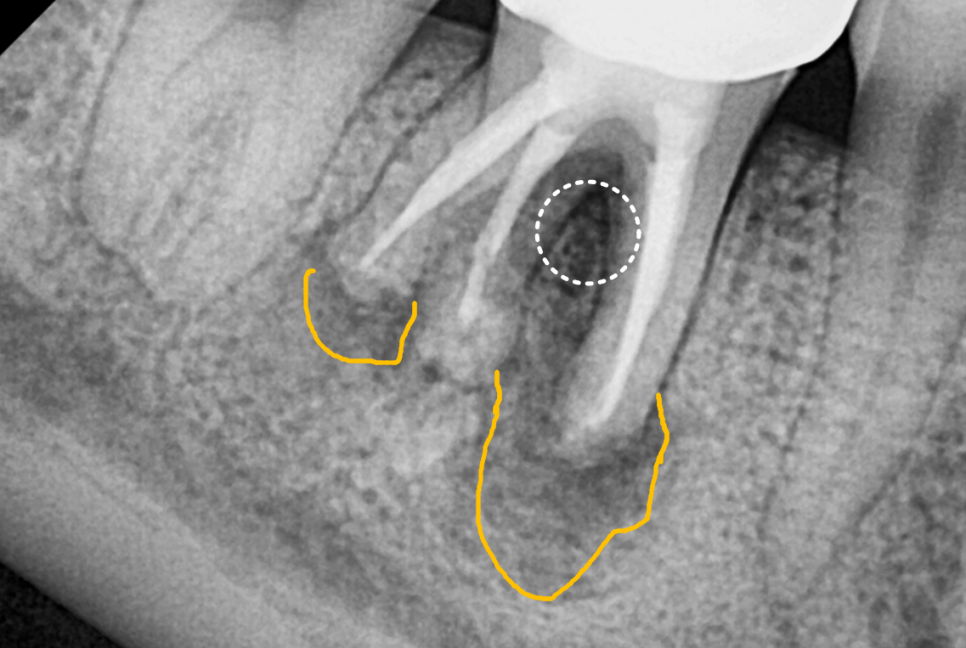 고덕동 20대 임플란트, 시기 놓치면 비용 2배 이상 듭니다. 관련 이미지 5