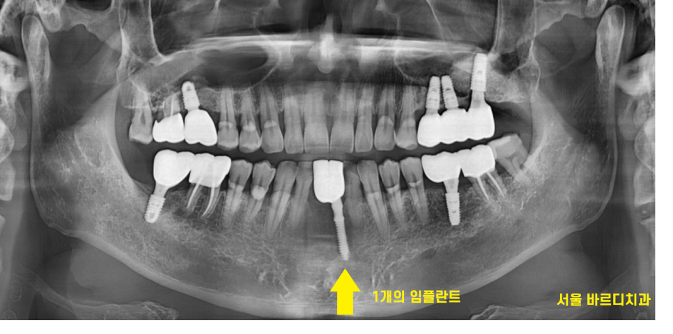 둔촌동 치과 아래 앞니 임플란트 뼈가 없을 때 일체형으로! 관련 이미지 9