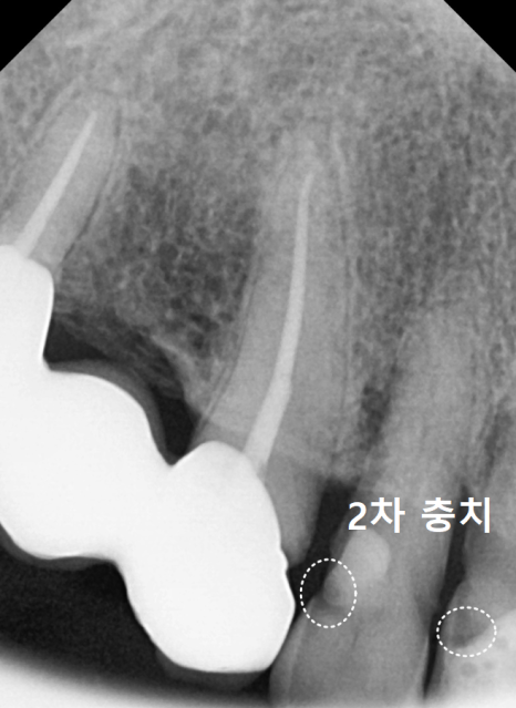 앞니 음식물 끼임, 왜 젊을 때보다 더 자주 발생하는 걸까요? 까맣게 변한 앞니 치료 사례 관련 이미지 6