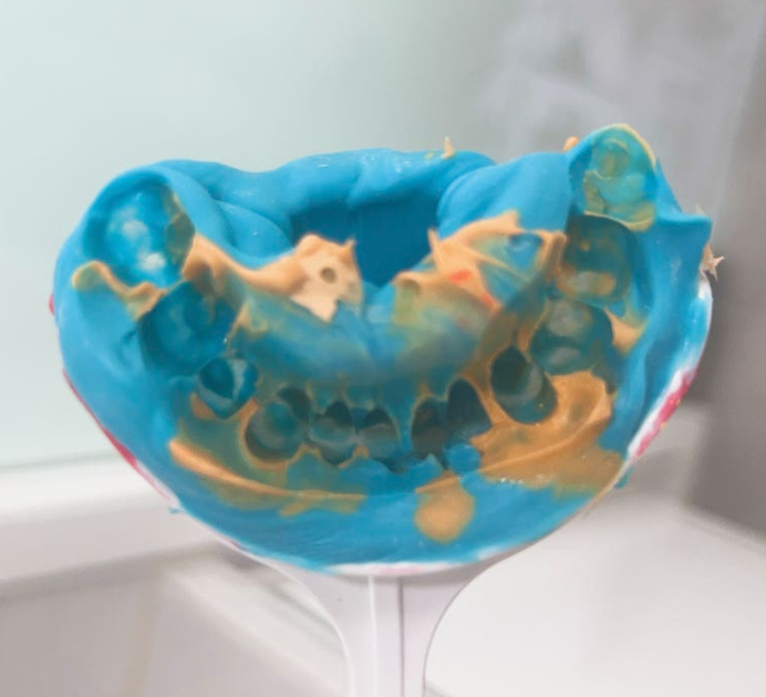 강동역 치과 3000만원의 값어치 구강스캐너를 사용합니다. 관련 이미지 2