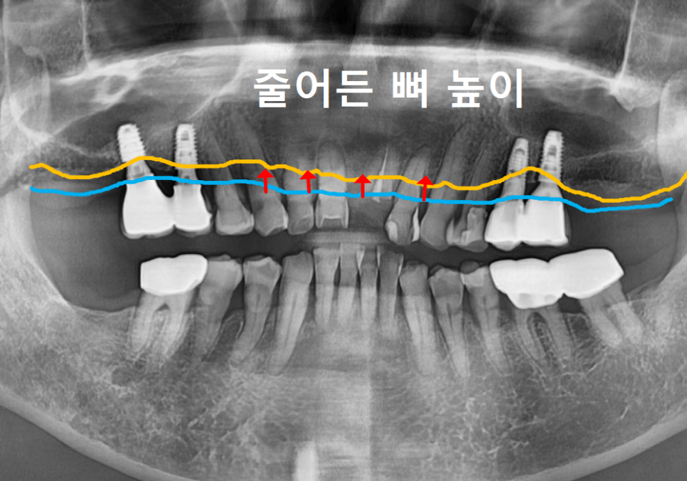 상일동역 치과 앞니 임플란트 기간 때문에 망설이신다면 꼭 보세요. 관련 이미지 3