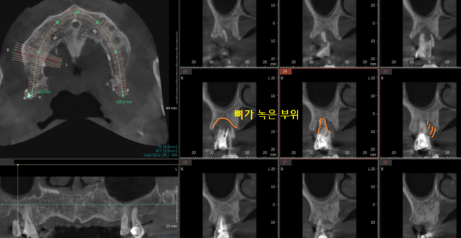 강일동 치과 치아 부러짐 붙일 수 있을까요?? 관련 이미지 6