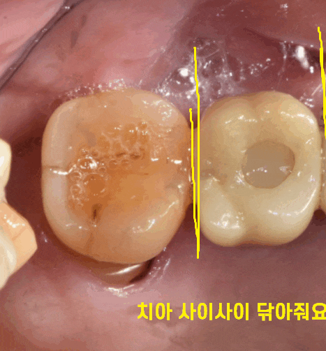명일동 치과 임플란트 주의사항 끝날 때까지 끝난게 아니다 관련 이미지 1